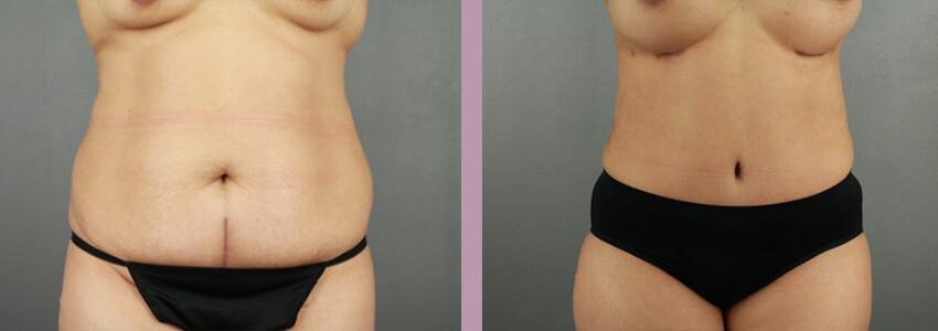 Case--18035 | Before and After Mommy Makeover 6