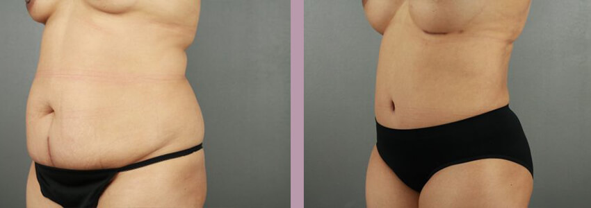 Case--18035 | Before and After Mommy Makeover 7