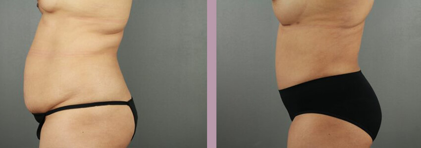 Case--18035 | Before and After Mommy Makeover 8