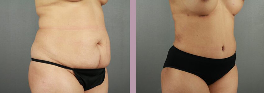 Case--18035 | Before and After Mommy Makeover 9