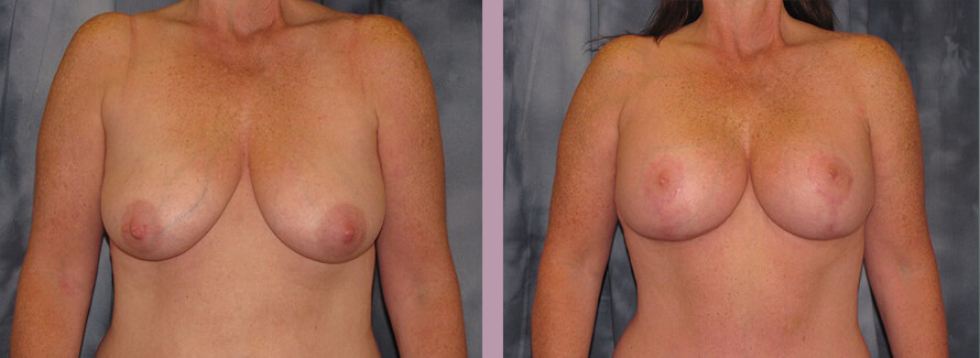 Case--2838 | Before and After Mommy Makeover