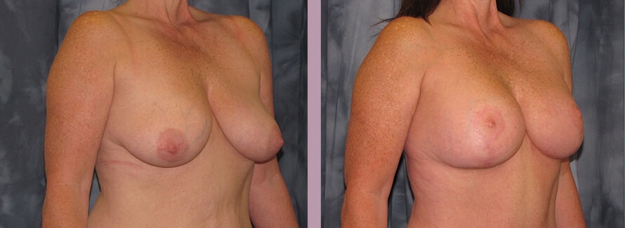 Case--2838 | Before and After Mommy Makeover 2