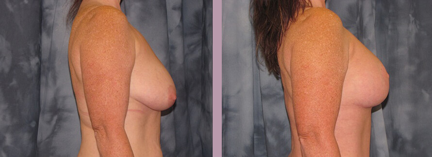 Case--2838 | Before and After Mommy Makeover 3