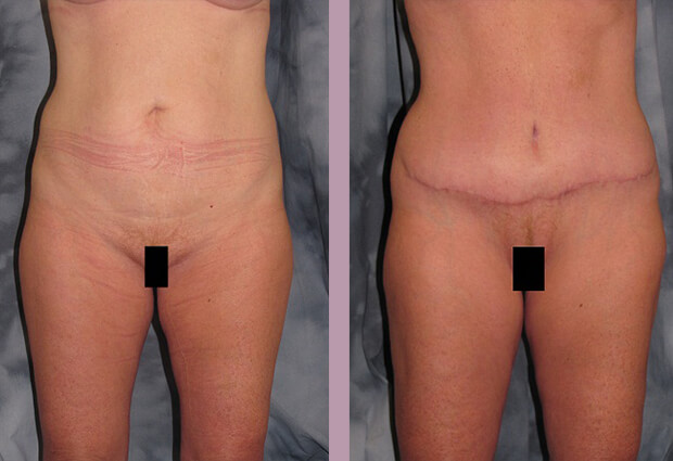 Case--2838 | Before and After Mommy Makeover 4