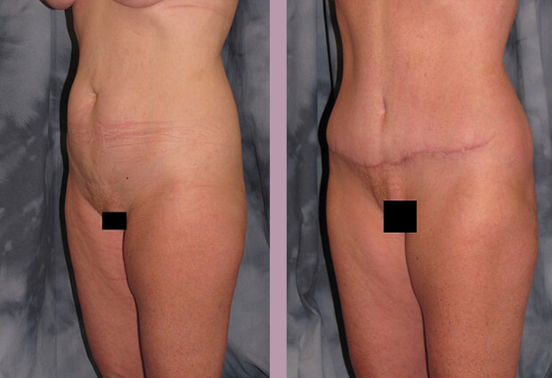 Case--2838 | Before and After Mommy Makeover 5