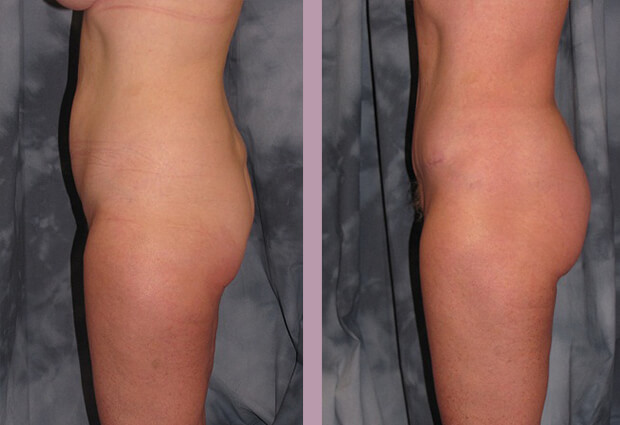 Case--2838 | Before and After Mommy Makeover 6