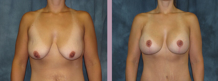 Case--2855 | Before and After Mommy Makeover