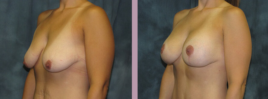 Case--2855 | Before and After Mommy Makeover 2