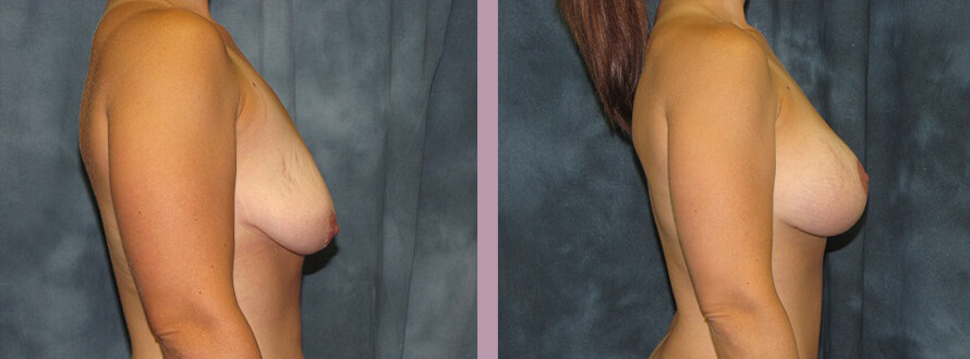 Case--2855 | Before and After Mommy Makeover 3