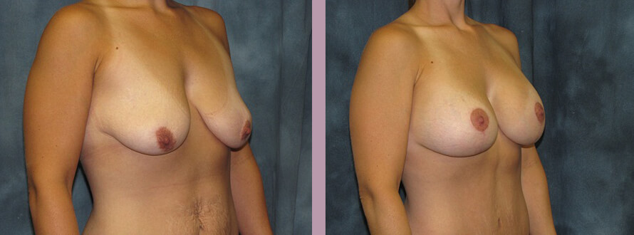 Case--2855 | Before and After Mommy Makeover 4