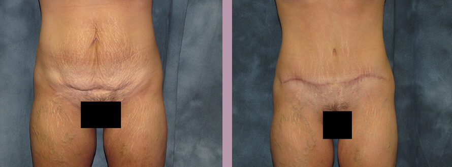 Case--2855 | Before and After Mommy Makeover 5