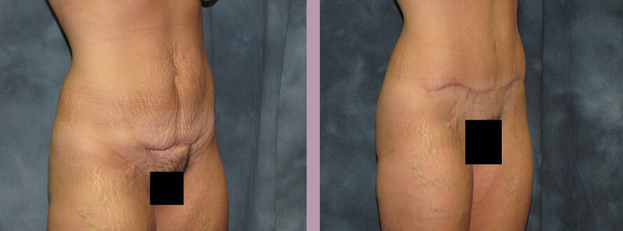 Case--2855 | Before and After Mommy Makeover 6