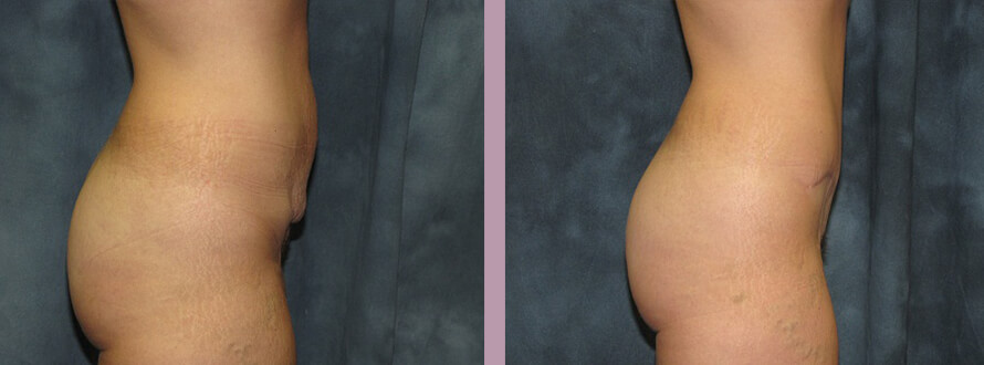 Case--2855 | Before and After Mommy Makeover 7