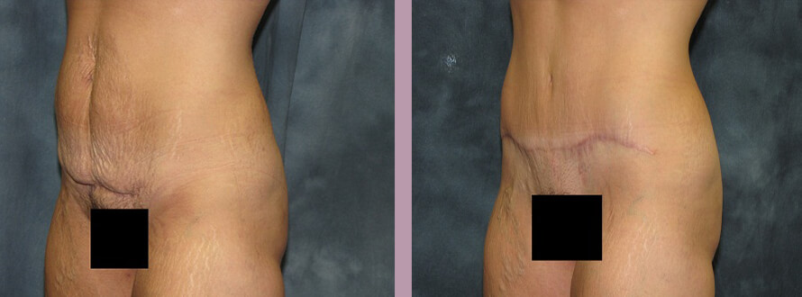 Case--2855 | Before and After Mommy Makeover 8