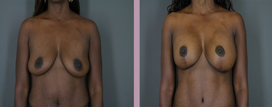 Case--4413 | Before and After Mommy Makeover