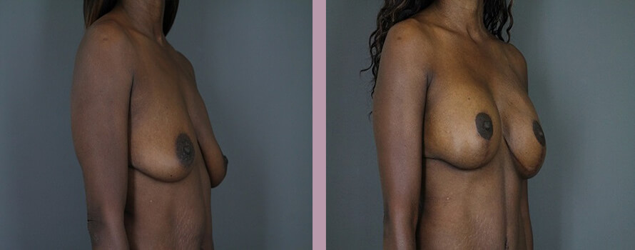 Case--4413 | Before and After Mommy Makeover 2