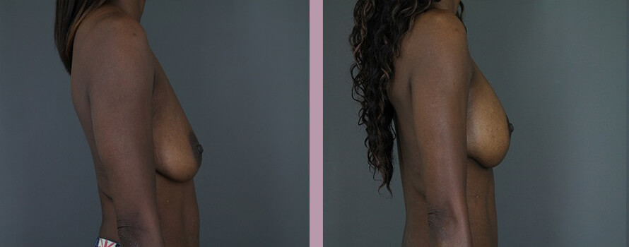 Case--4413 | Before and After Mommy Makeover 3