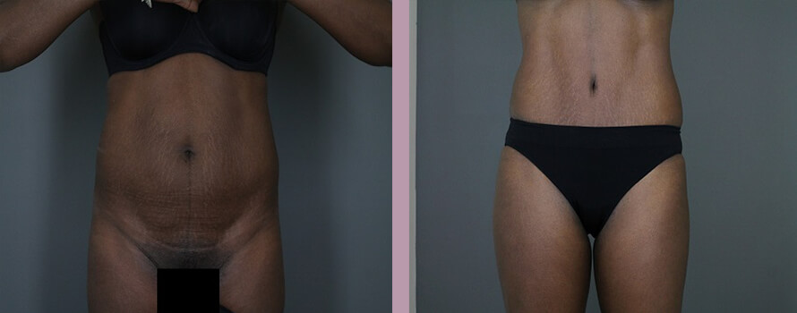 Case--4413 | Before and After Mommy Makeover 4