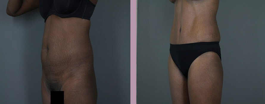 Case--4413 | Before and After Mommy Makeover 5