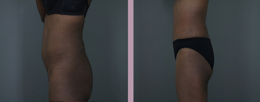 Case--4413 | Before and After Mommy Makeover 6