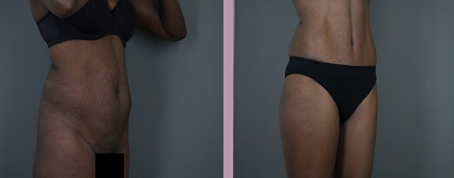 Case--4413 | Before and After Mommy Makeover 7