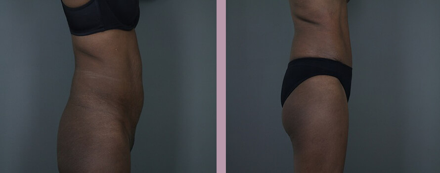 Case--4413 | Before and After Mommy Makeover 8