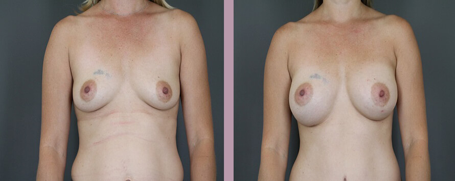 Case--5326 | Before and After Mommy Makeover