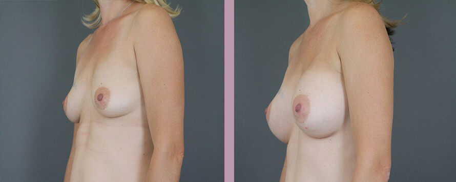 Case--5326 | Before and After Mommy Makeover 2