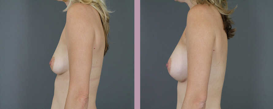 Case--5326 | Before and After Mommy Makeover 3