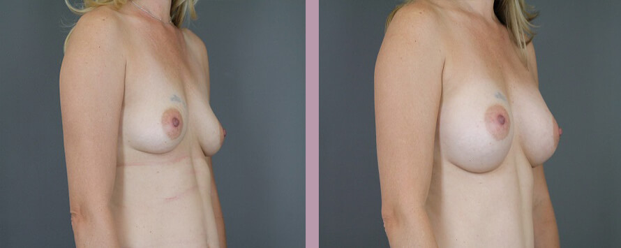 Case--5326 | Before and After Mommy Makeover 4