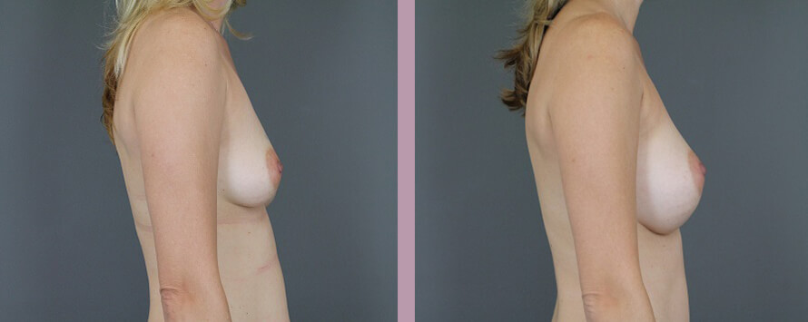 Case--5326 | Before and After Mommy Makeover 5