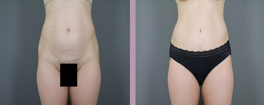 Case--5326 | Before and After Mommy Makeover 6