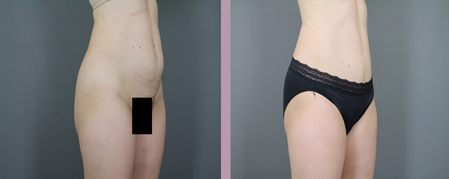 Case--5326 | Before and After Mommy Makeover 7