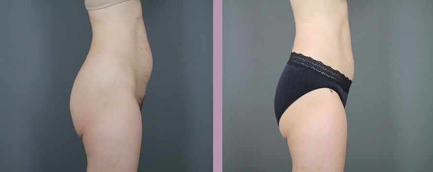 Case--5326 | Before and After Mommy Makeover 8