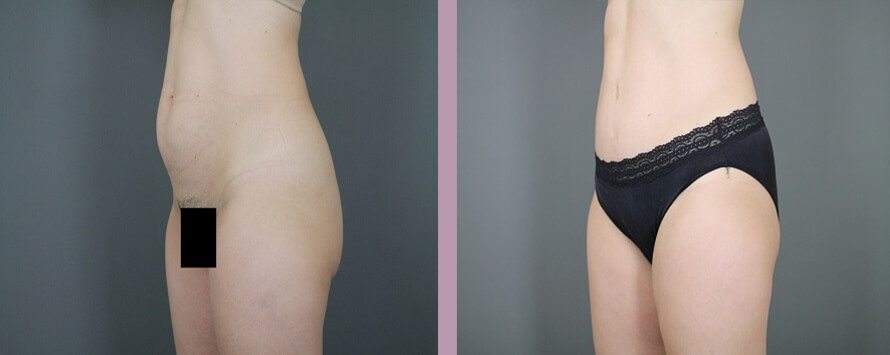 Case--5326 | Before and After Mommy Makeover 9