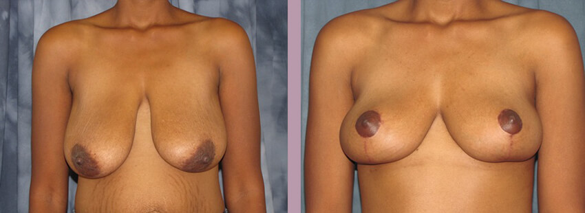 Case--852 | Before and After Mommy Makeover