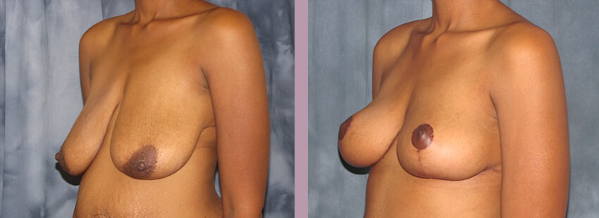 Case--852 | Before and After Mommy Makeover 2