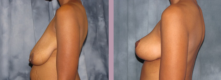 Case--852 | Before and After Mommy Makeover 3