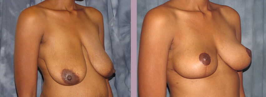 Case--852 | Before and After Mommy Makeover 4