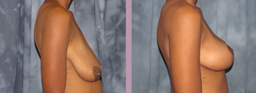 Case--852 | Before and After Mommy Makeover 5