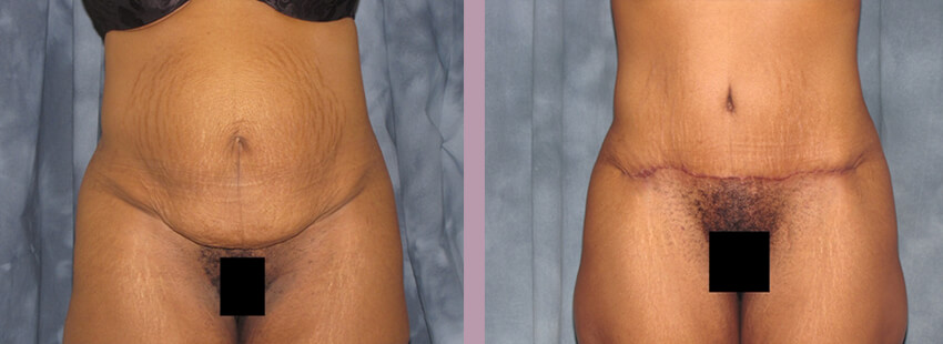 Case--852 | Before and After Mommy Makeover 6