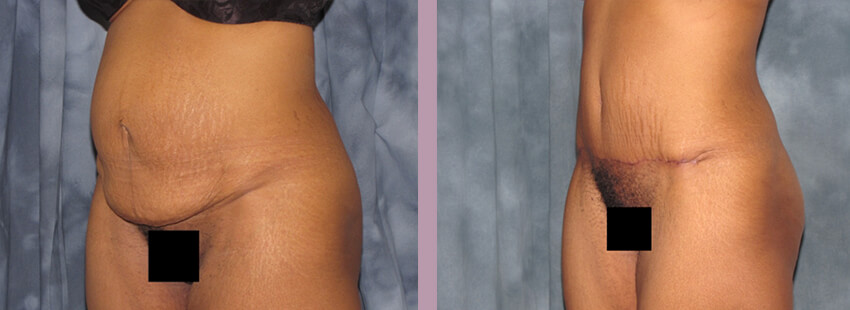 Case--852 | Before and After Mommy Makeover 7