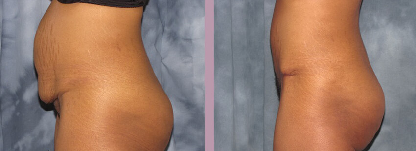 Case--852 | Before and After Mommy Makeover 8