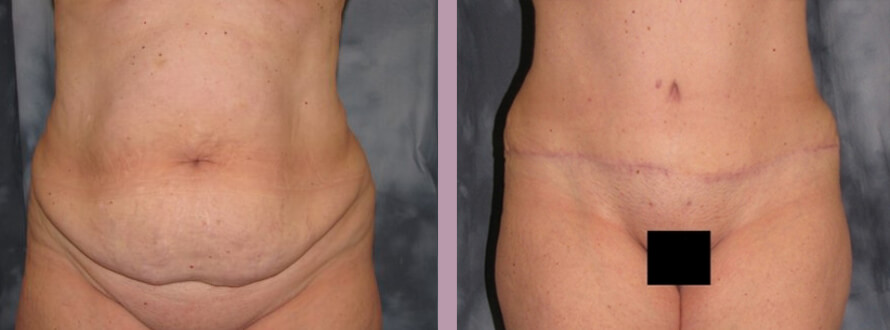 Case--872 | Before and After Mommy Makeover