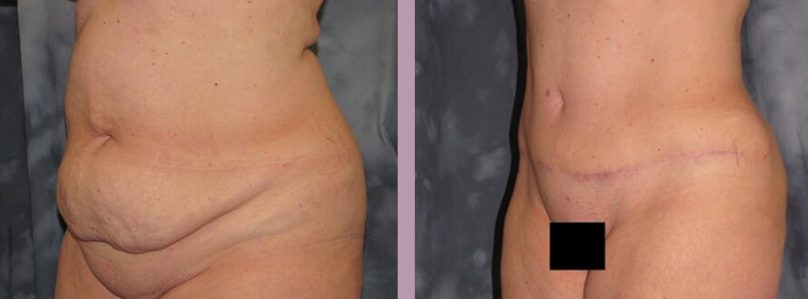 Case--872 | Before and After Mommy Makeover 2