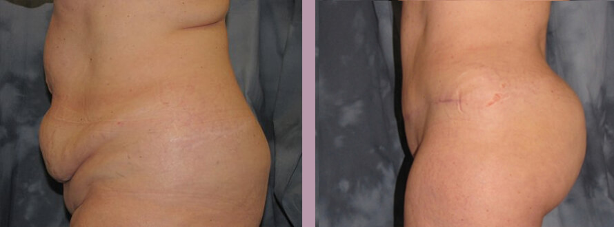 Case--872 | Before and After Mommy Makeover 3