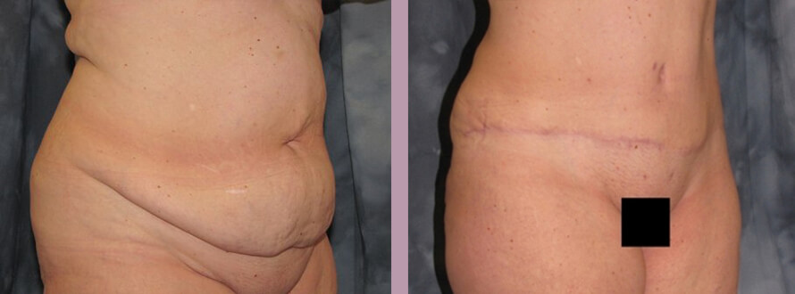 Case--872 | Before and After Mommy Makeover 4