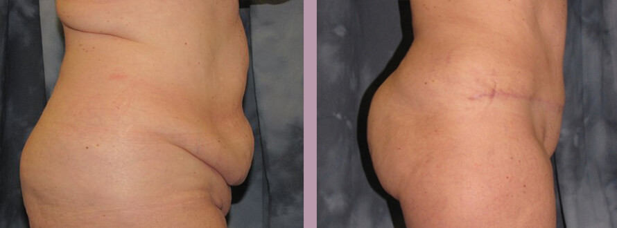 Case--872 | Before and After Mommy Makeover 5