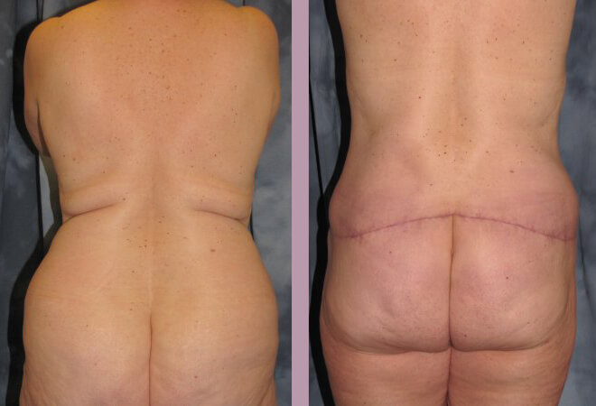 Case--872 | Before and After Mommy Makeover 6