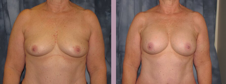 Case--872 | Before and After Mommy Makeover 7